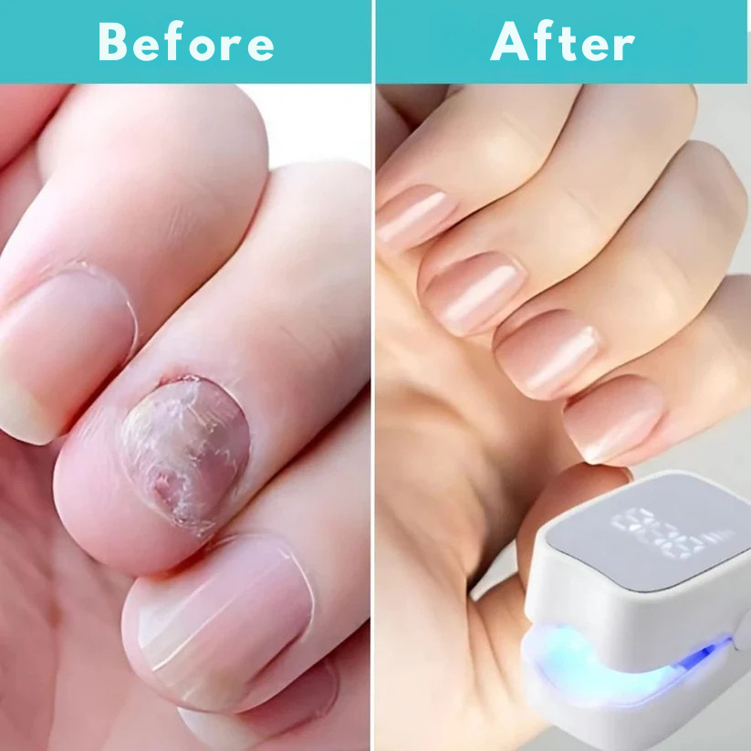 The Ultimate Drug-Free Laser Solution Against Nail Fungus