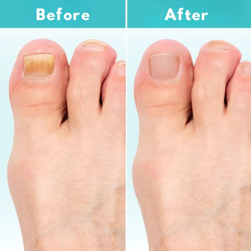The Ultimate Drug-Free Laser Solution Against Nail Fungus